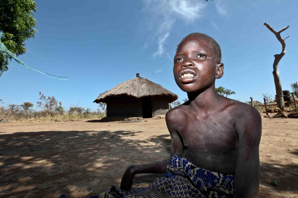 The diagnosis was wrong, then in 2008, she started developing symptoms that looked different from the known signs of epilepsy. This time, doctors were not able to define the disease she was suffering from, it is now known as ‘nodding disease’ and has affected thousands of children across Acholi region.