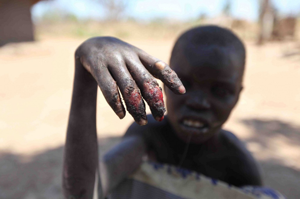 This is Nancy Lamwaka whose father Michael Odongkara, says is withering away before their very own eyes. Half naked, pale, looking tired and with her legs tied together, Lamwaka dreads every single that goes by. Her hands are scarred and rotting away from burns she obtained after she fell into a fire during an attack.