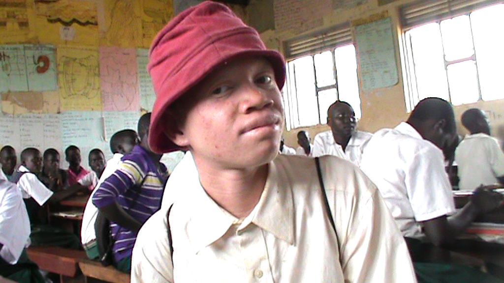 Nwoya Albino Boy Whose Story Was Broken By Acholi Times 3 years Ago  Wants To Be Doctor